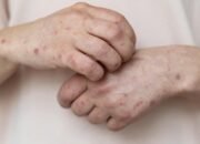 [Campak di Banten Ancam Menjadi KLB, Dinkes Ditekan Jamin Stok Obat dan Vaksin]