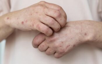 [Campak di Banten Ancam Menjadi KLB, Dinkes Ditekan Jamin Stok Obat dan Vaksin]