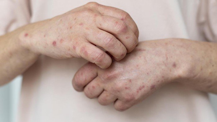 [Campak di Banten Ancam Menjadi KLB, Dinkes Ditekan Jamin Stok Obat dan Vaksin]