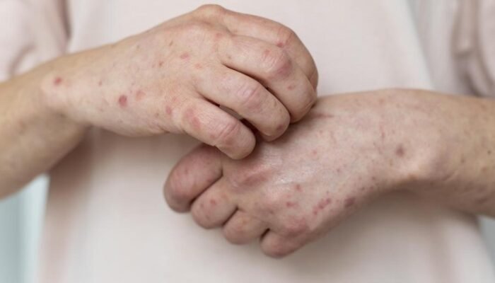 [Campak di Banten Ancam Menjadi KLB, Dinkes Ditekan Jamin Stok Obat dan Vaksin]